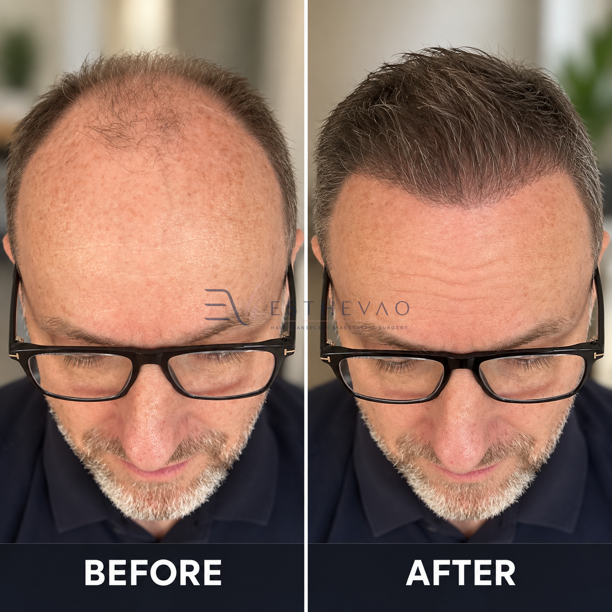 ESTHEVAO hair restoration before and after comparison 1