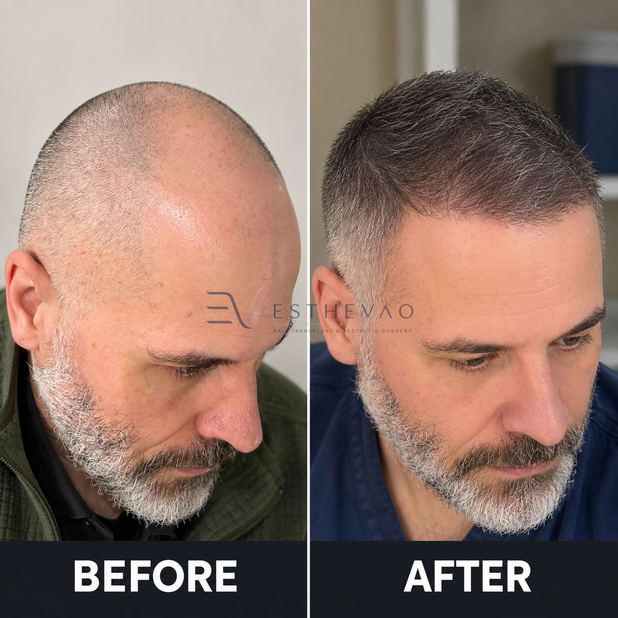 esthevao-before-after-3