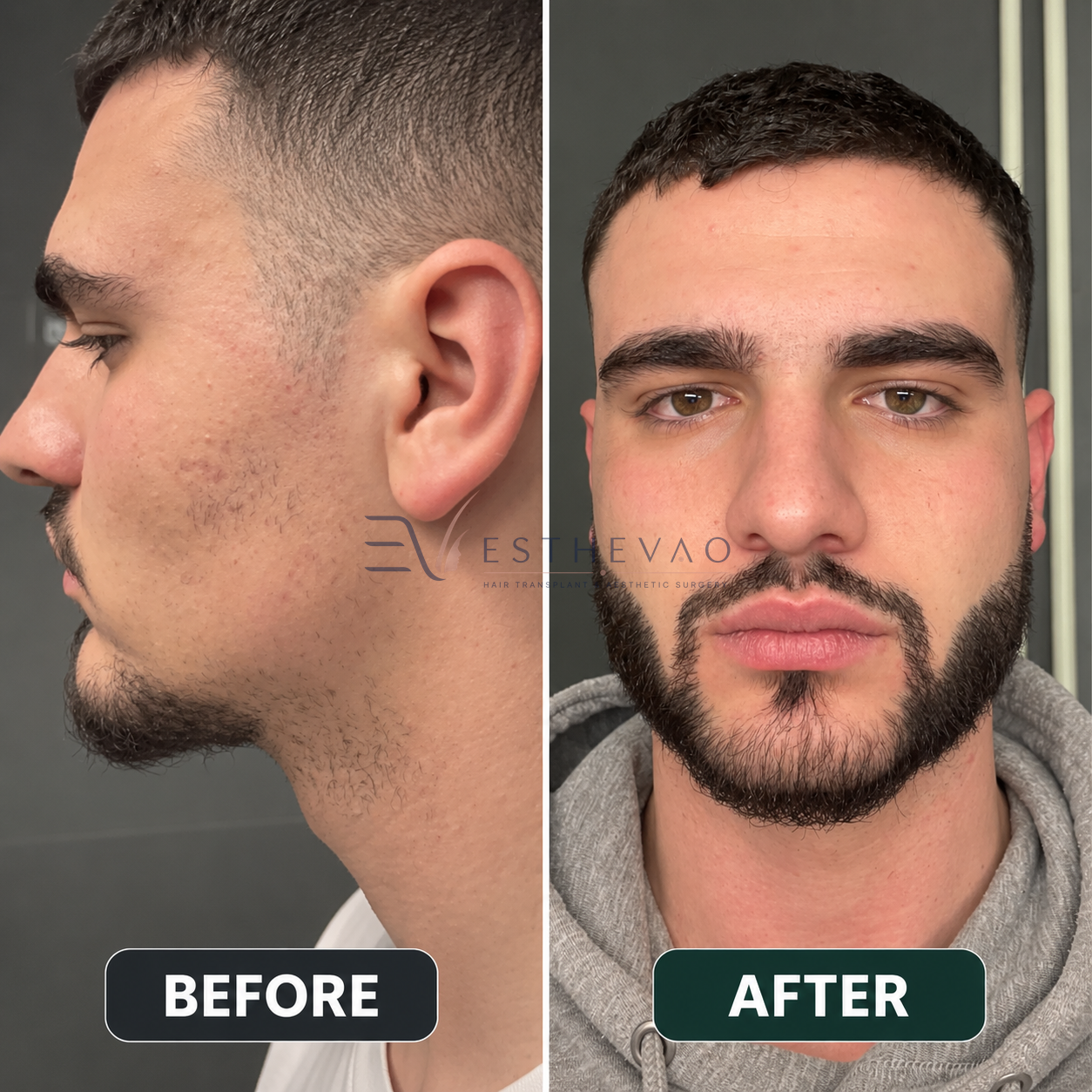 esthevao-before-after-4